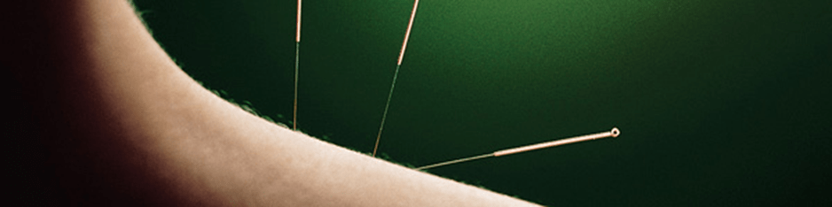 Acupuncture